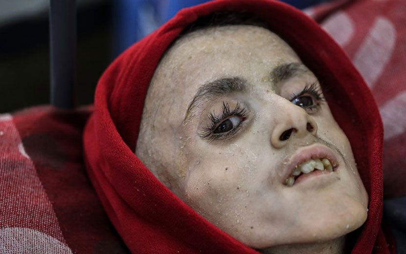 Gazze’de 10 Çocuk Açlıktan Öldü